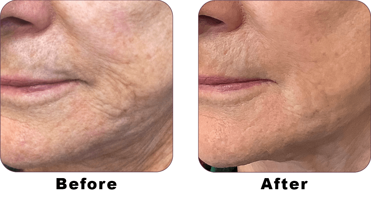 ULTHERA BEFORE AND AFTER